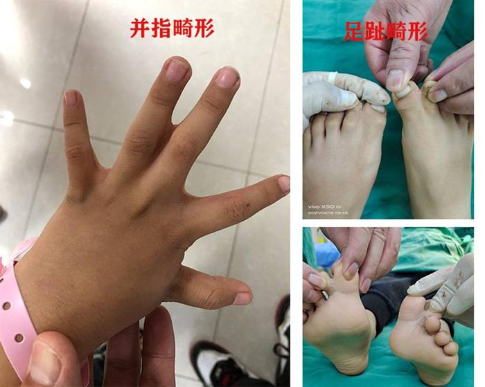 固镇县中医院外二科成功开展一例并指畸形矫形术 - 固镇县中医院